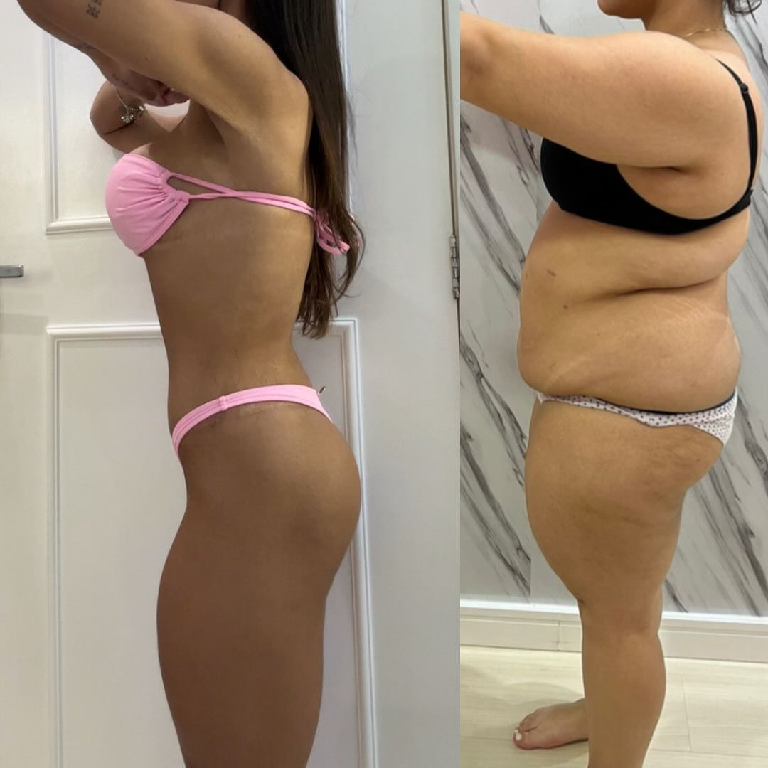 Antes e depois de cirurgia plástica pós-bariátrica